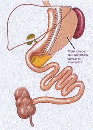 Sleeve Gastrectomy 70.gif